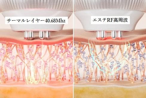 最新40.68MHzのRF高周波機器【シワ、たるみ、ほうれい線改善】220万円→