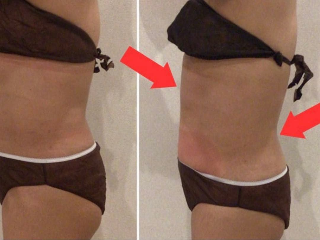 2025脂肪冷却マシン/360脂肪冷却