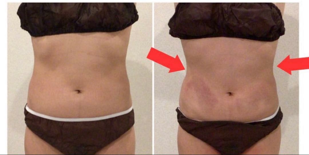 2025脂肪冷却マシン/360脂肪冷却