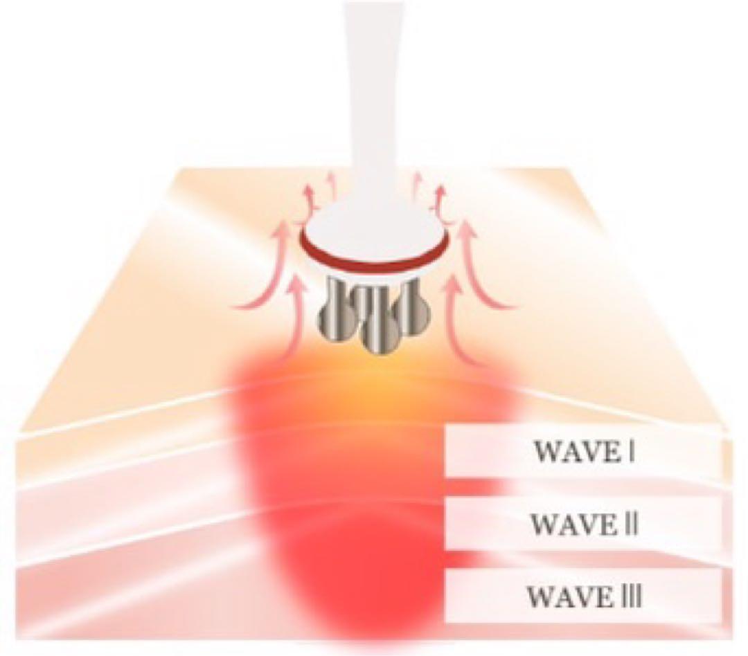 ファシア干渉波美容機器