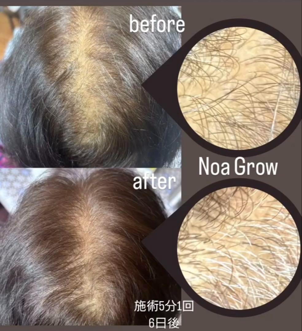 ドクタービセア 美容液導入 MTS ノアグロウ同型＋チップ14個+スカルプケア